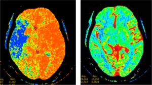 PERFUSION CT