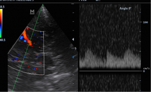 doppler test1