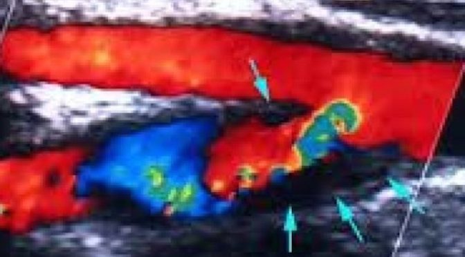 ULTRASOUND STROKE